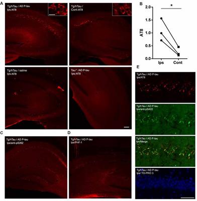 Pathological Tau From Alzheimer’s Brain Induces Site-Specific Hyperphosphorylation and SDS- and Reducing Agent-Resistant Aggregation of Tau in vivo